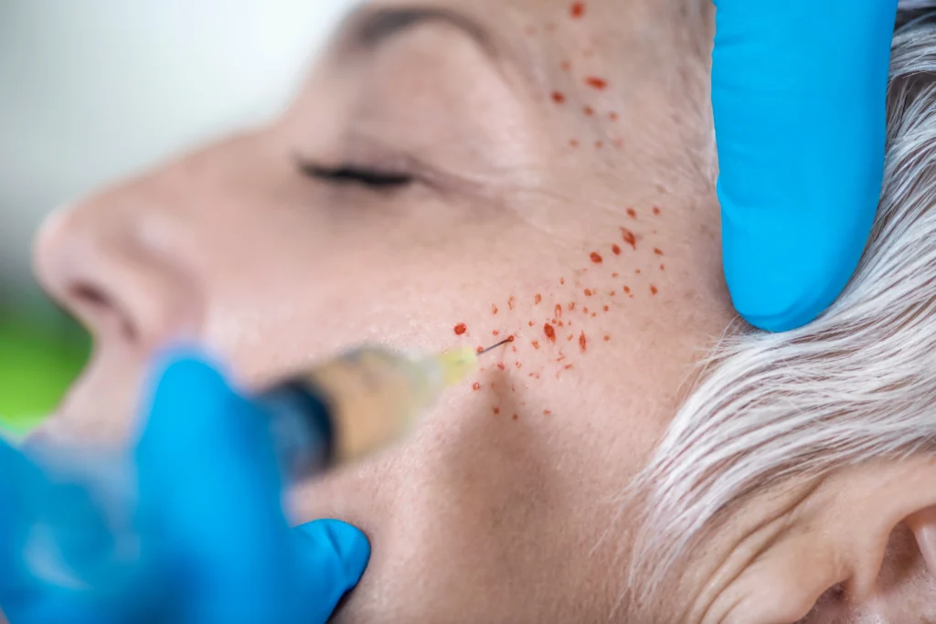 Platelet Rich Plasma PRP Treatment