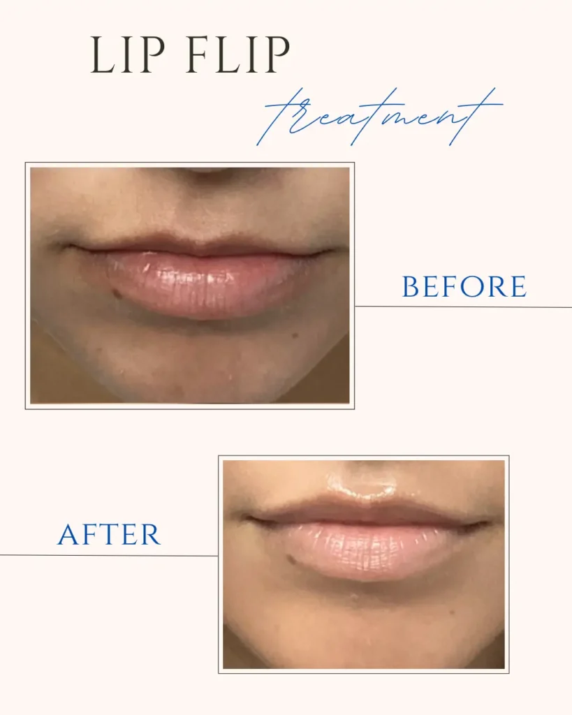 Lip Filler
