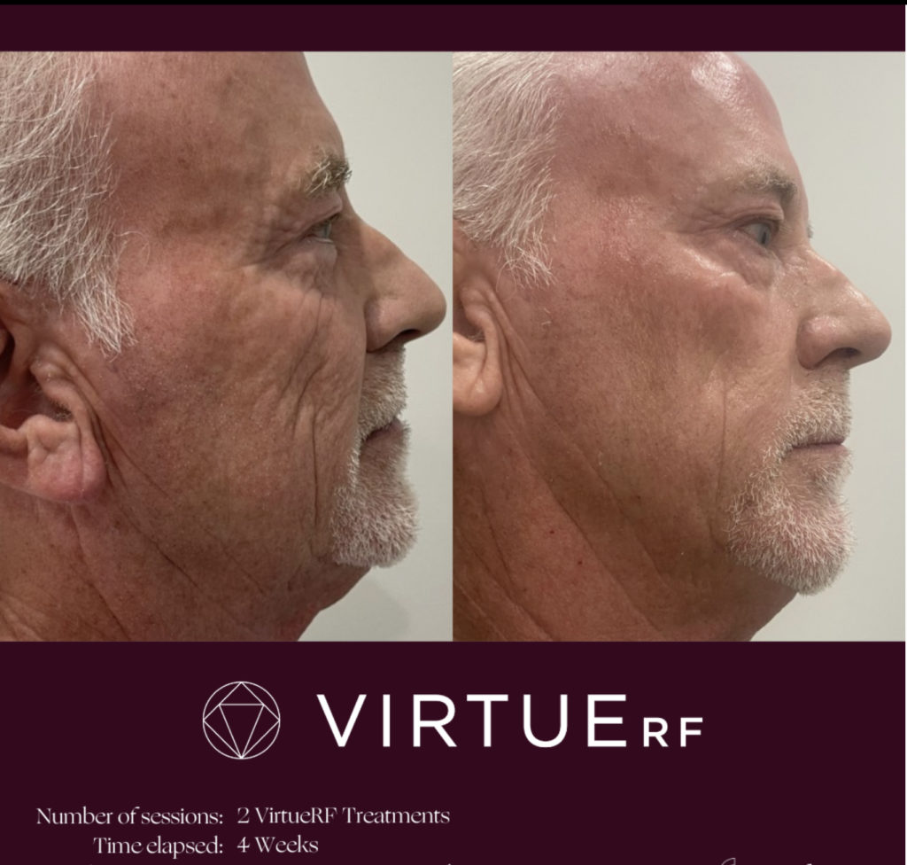 BA radio frequency microneedeling