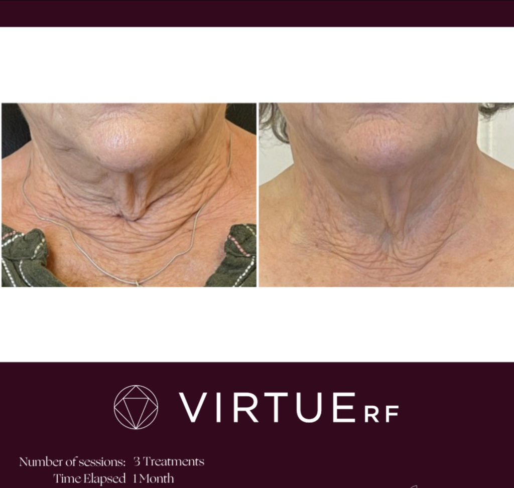 radio frequency microneedeling BA